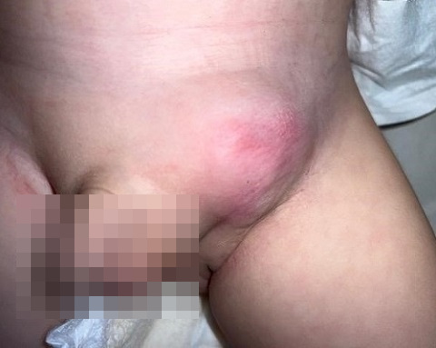 Figura 1. Masa inguinal izquierda de 5 días de evolución de coloración violácea